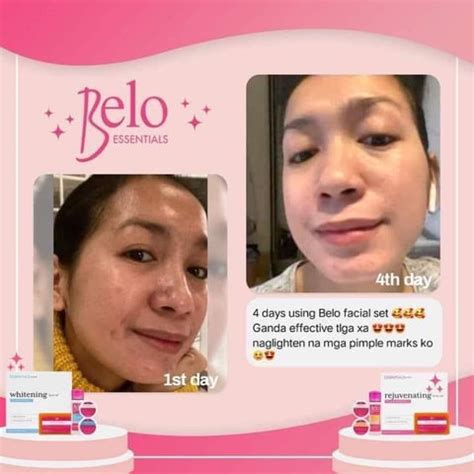 belo facials|Belo Facial for Teen Acne .
